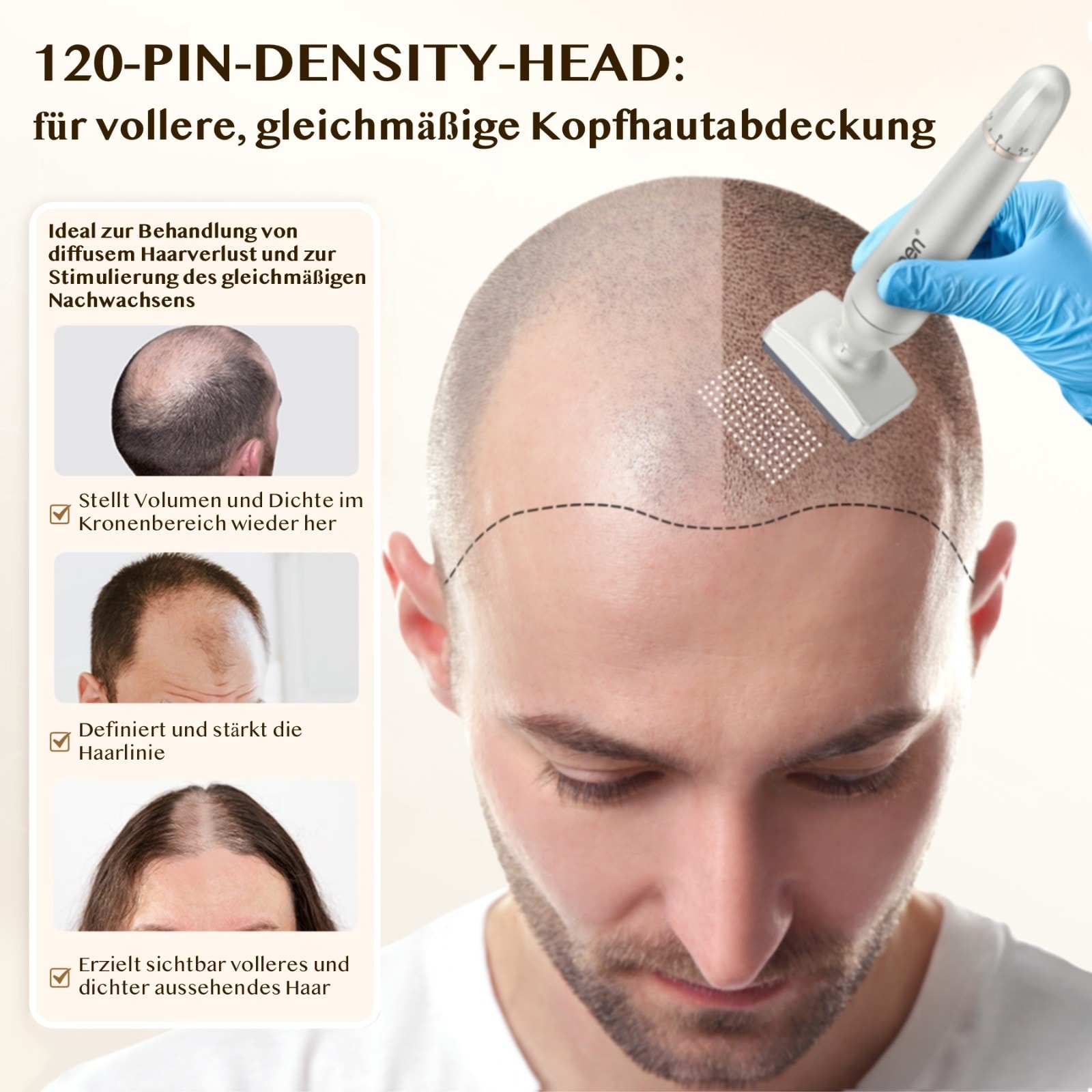 Derma Stamp Mesoroller Microneedling Dermapenn  BIOPEN BIO4 2 Aufsätze Edelstall Nadeln 0-3mm