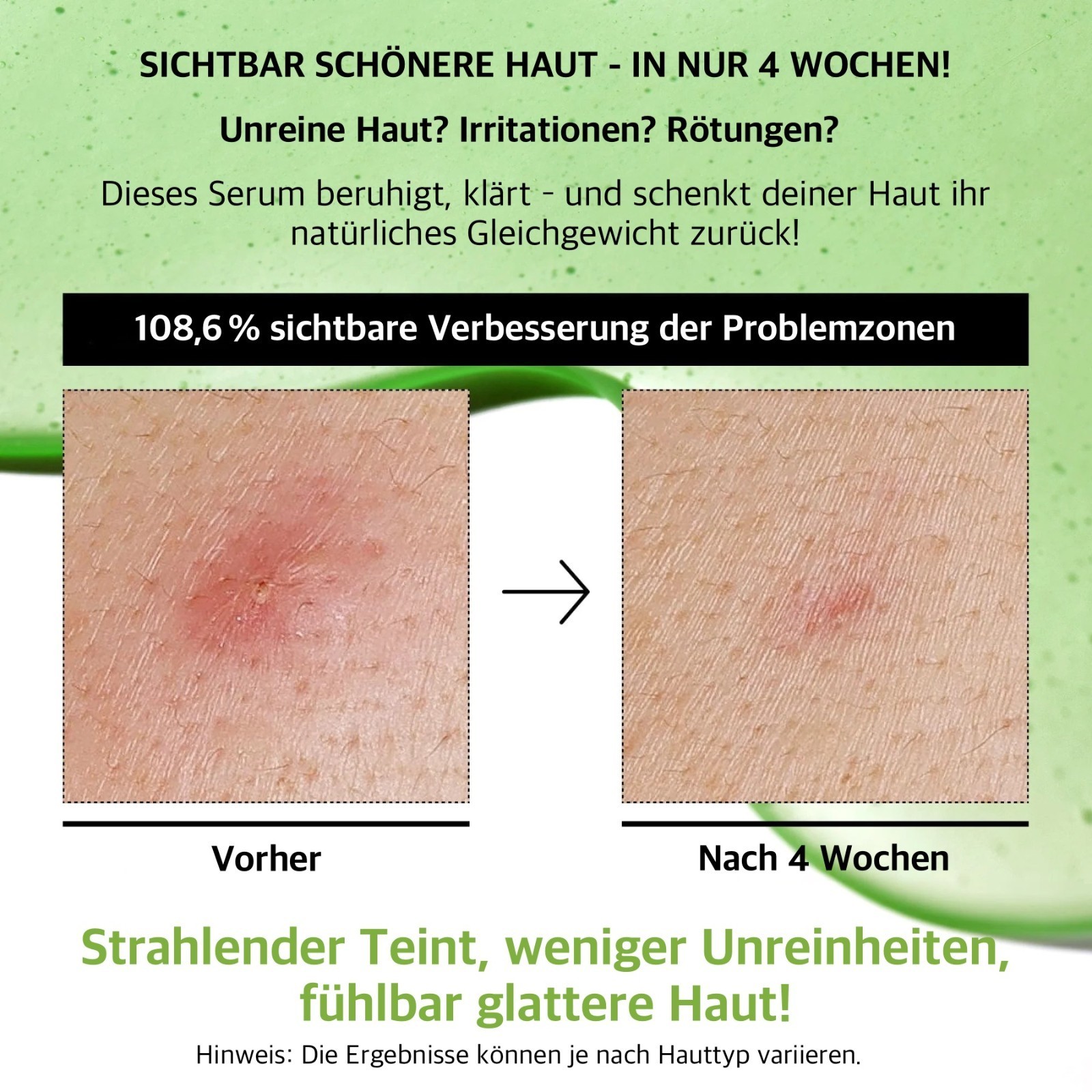 Gesichtsserum Anua 10% Acelaic Acid Hyaluron Redness Soothing Serum 30ml